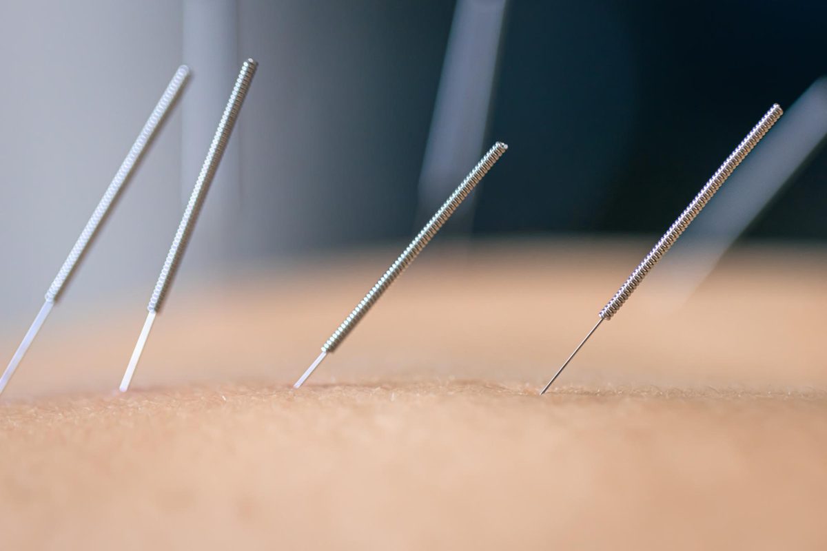 Acupuncture in Levittown, NY